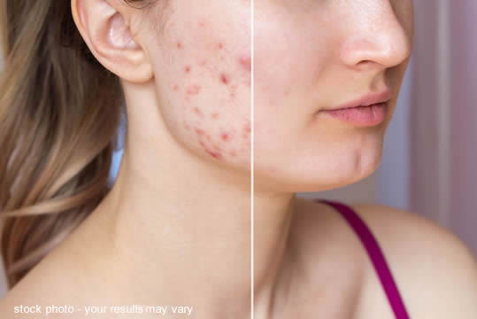 Young woman with acne on face before and after
