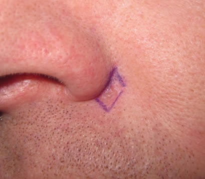 Skin cancer on face near nose pre MOHS surgery