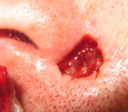 Skin cancer on face open wound post MOHS surgery